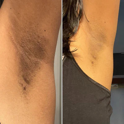 Kojic + Turmeric Body Peel Spray